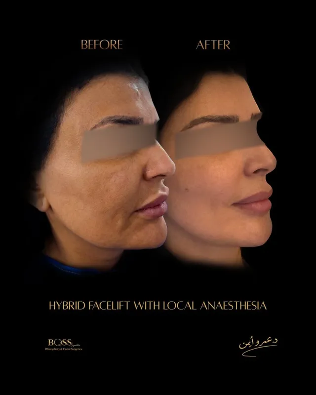 Before and after — Dr. Amr Ayman