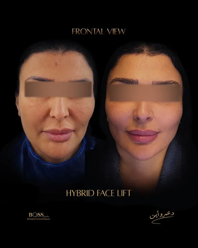Before and after — Dr. Amr Ayman