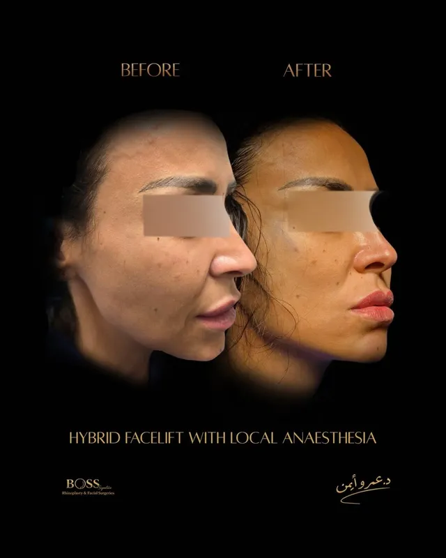 Before and after — Dr. Amr Ayman