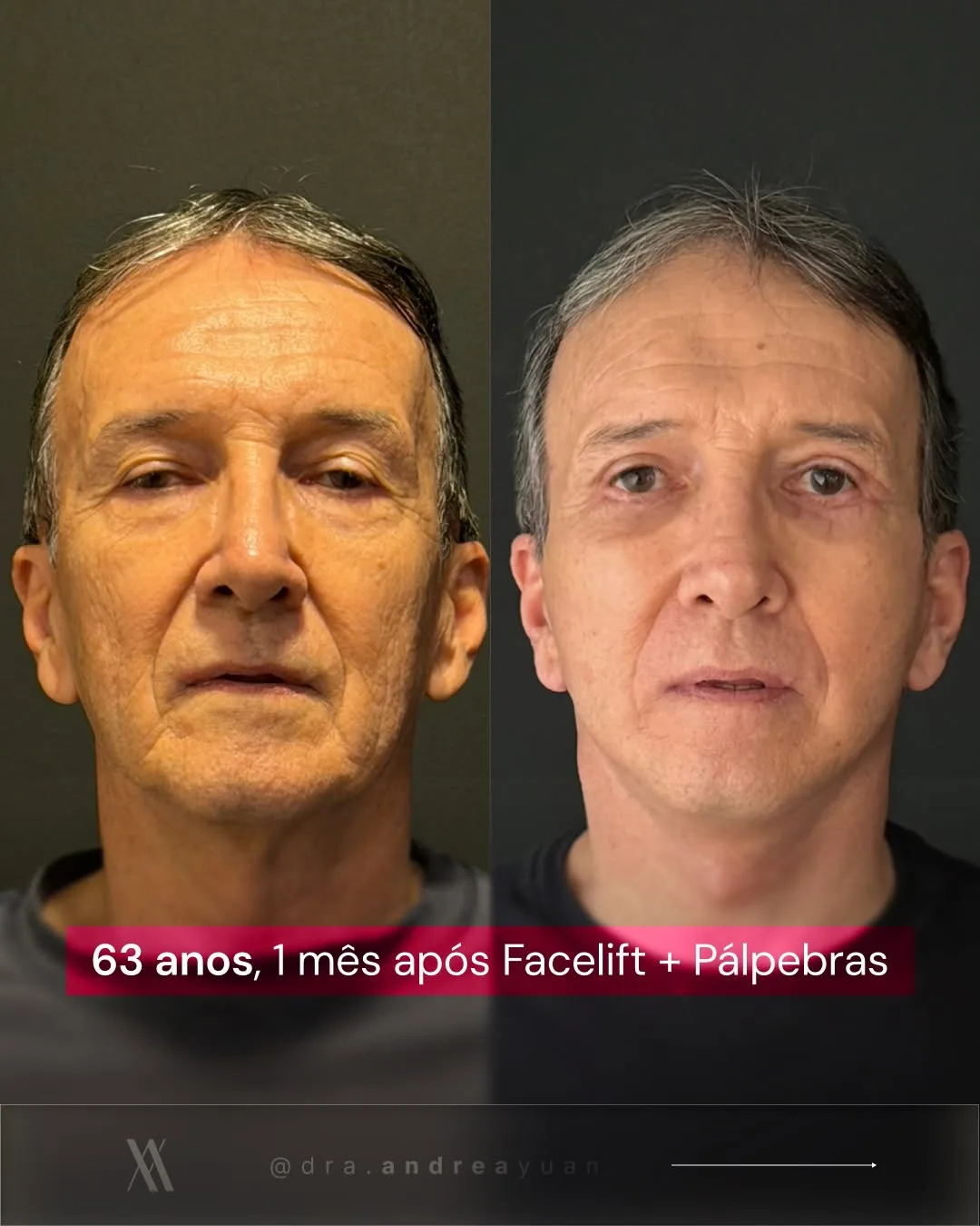 Before and after — Dr. Andrea Yuan
