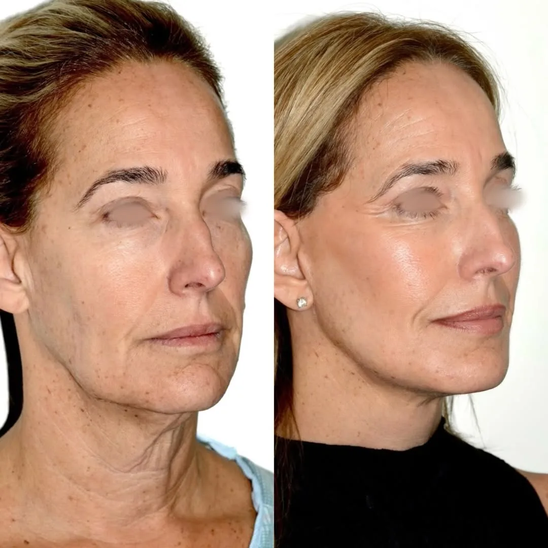 Before and after deep plane facelift — 55-year-old woman, three-quarter view, 3mo post-op by Dr. Andres Bustillo