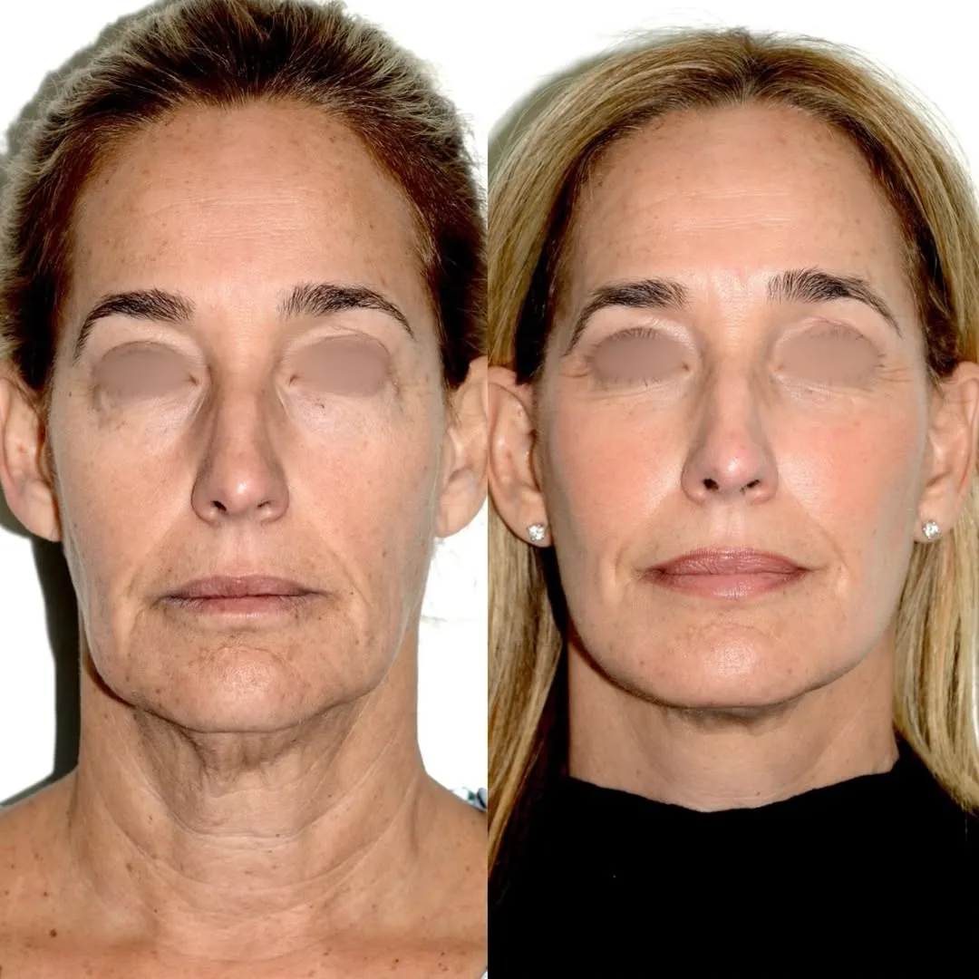 Before and after deep plane facelift — 55-year-old woman, frontal view, 3mo post-op by Dr. Andres Bustillo
