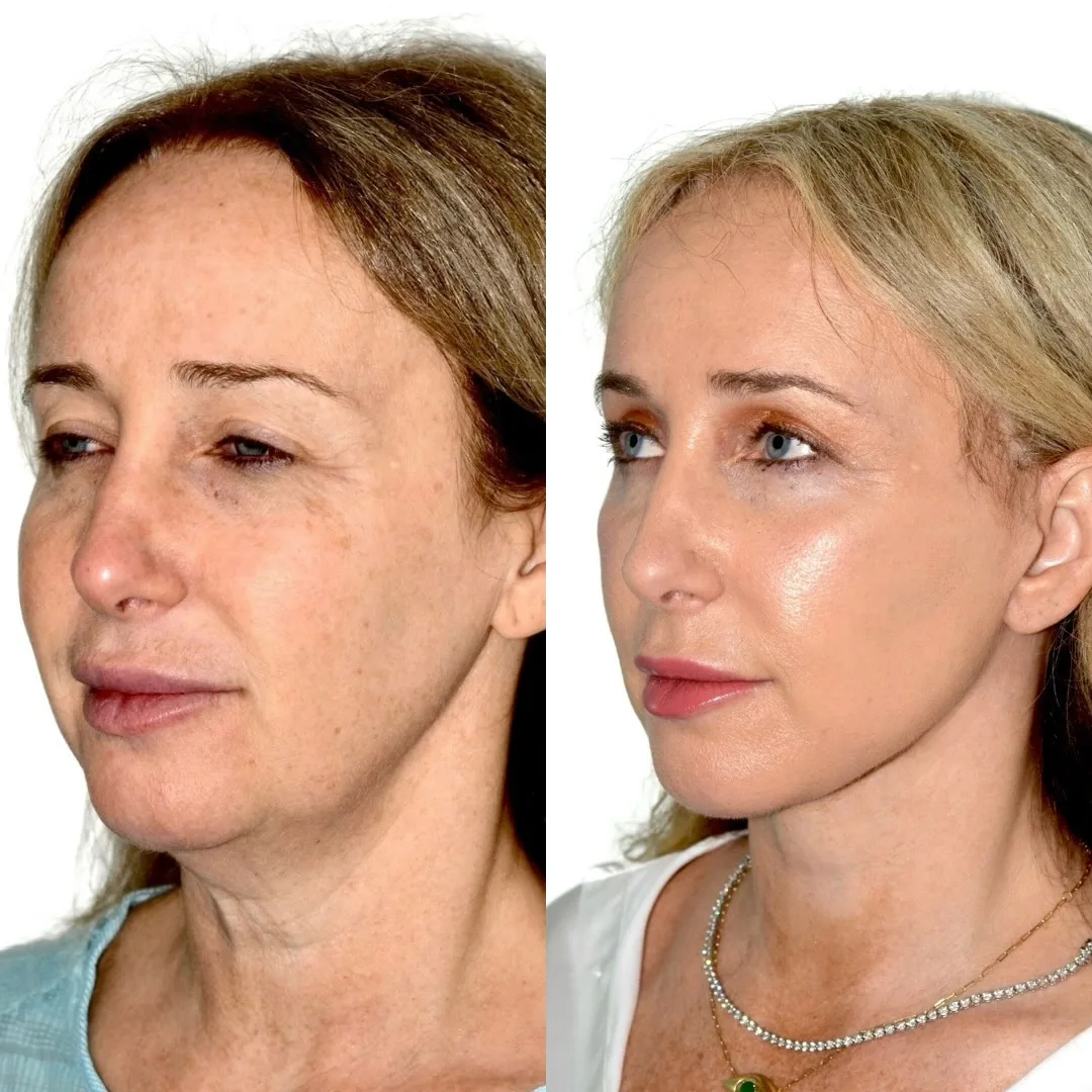 Before and after deep plane facelift — 52-year-old woman, oblique left view, 6mo post-op by Dr. Andres Bustillo