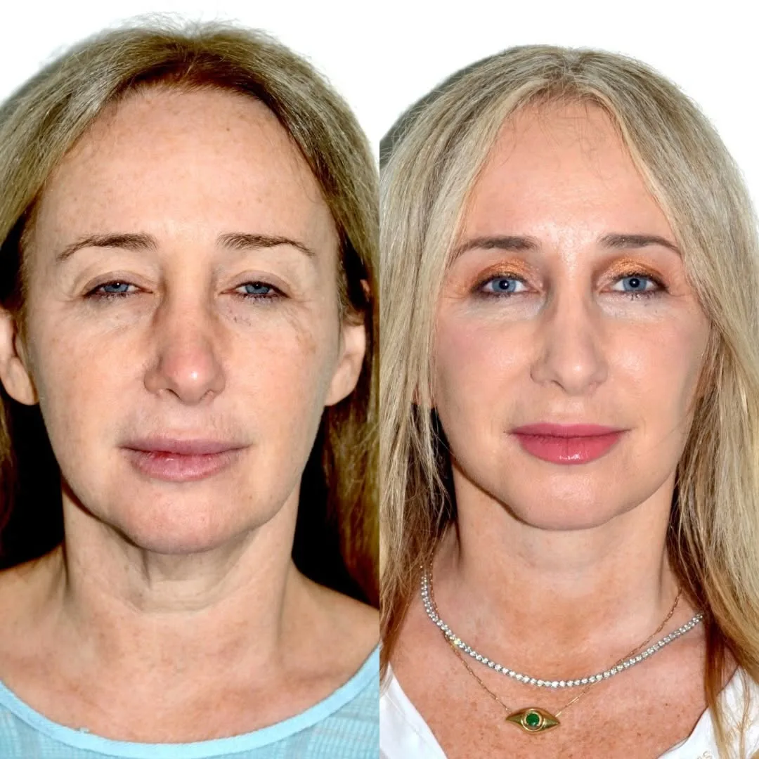 Before and after deep plane facelift — 55-year-old woman, frontal view, 7mo post-op by Dr. Andres Bustillo