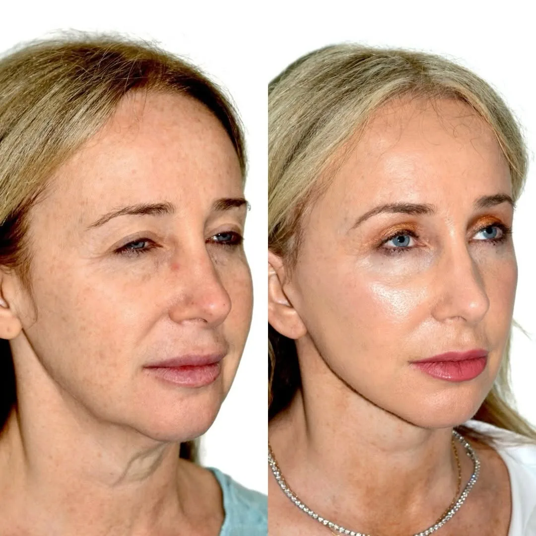 Before and after deep plane facelift — 55-year-old woman, oblique left view, 6mo post-op by Dr. Andres Bustillo