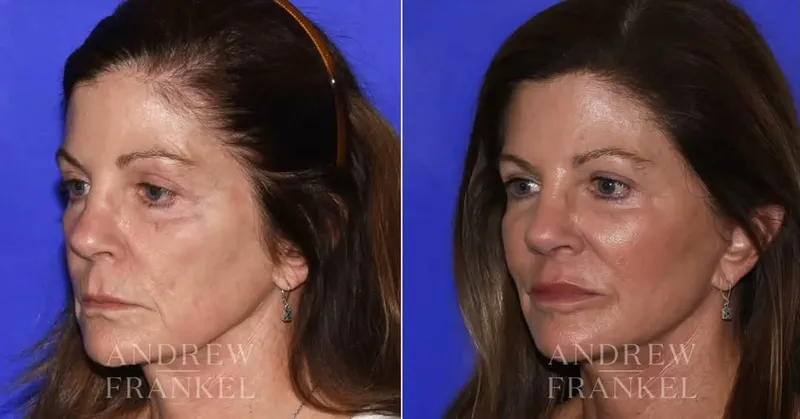 Before and after — Dr. Andrew Frankel