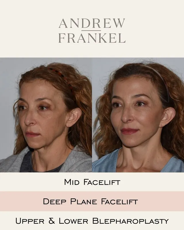 Before and after — Dr. Andrew Frankel