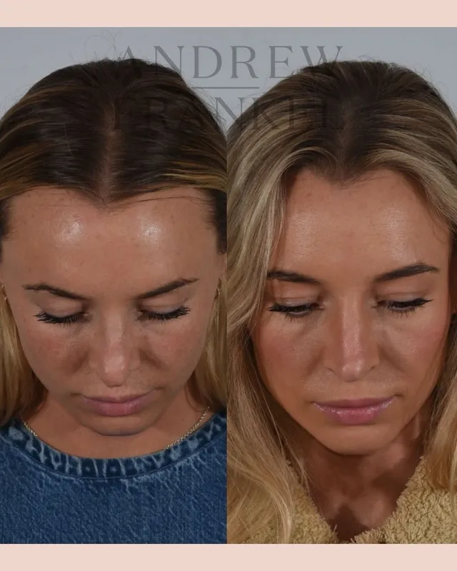 Before and after — Dr. Andrew Frankel