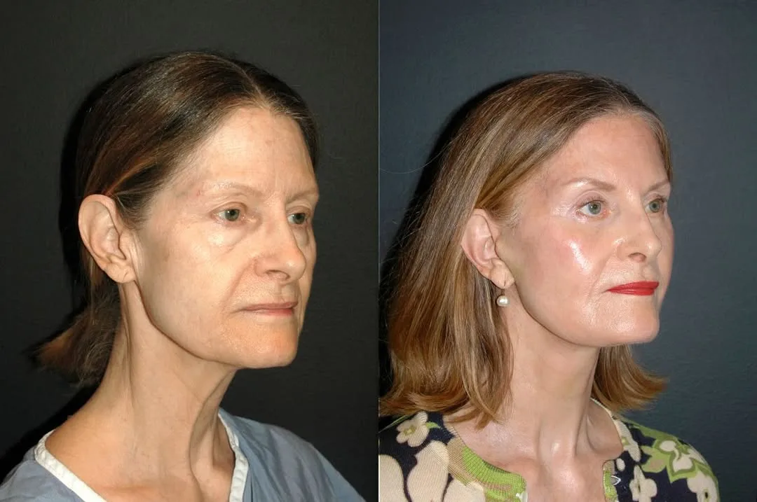 Before and after — Dr. Andrew Jacono