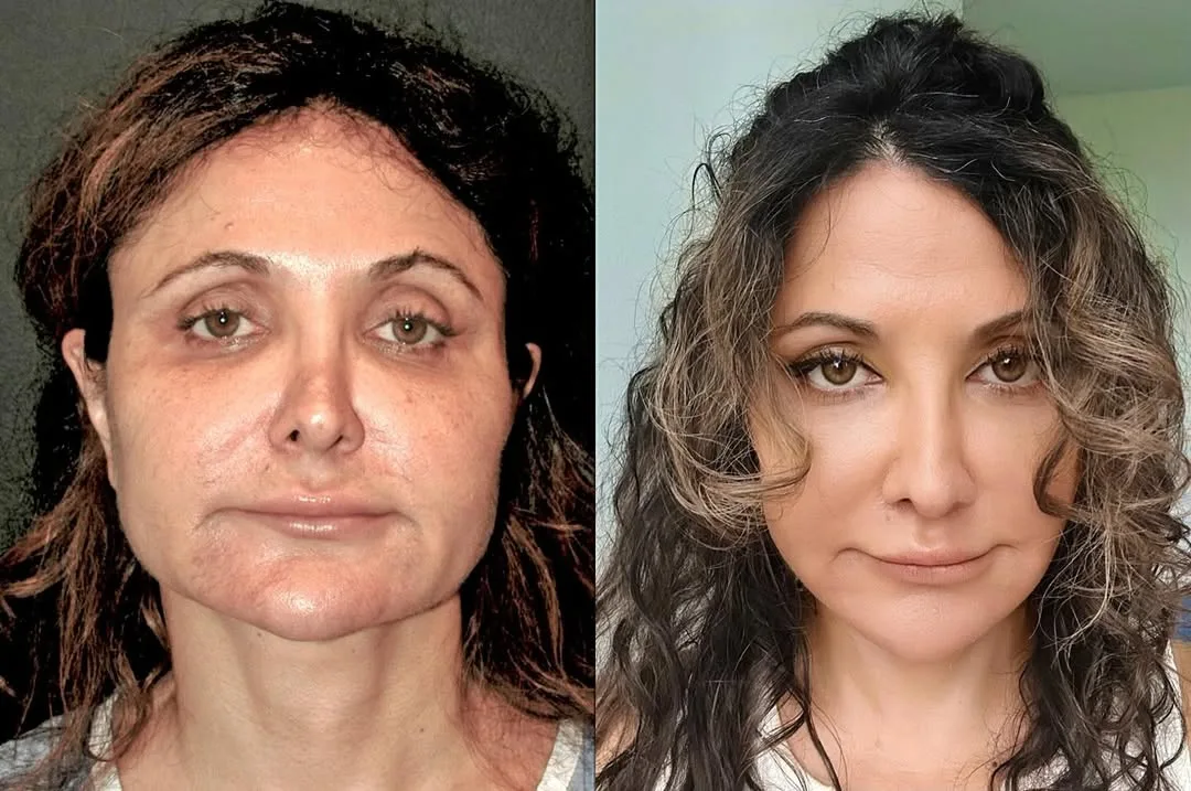 Before and after — Dr. Andrew Jacono