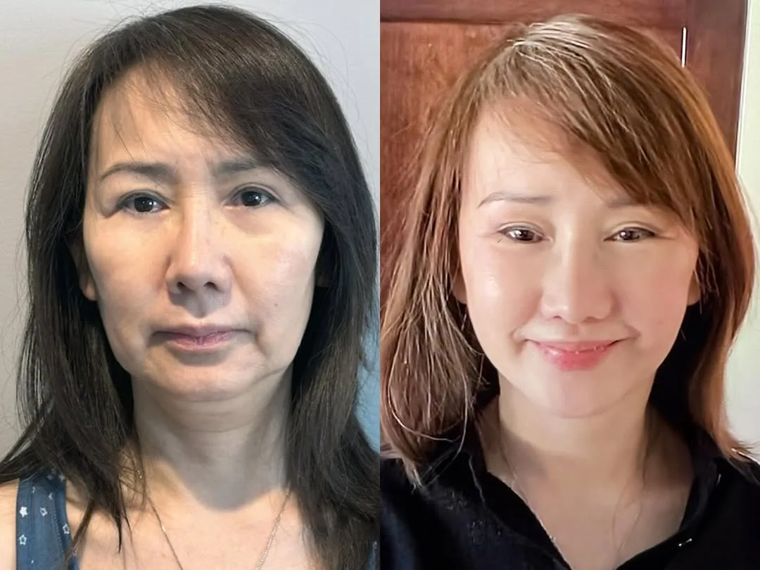 Before and after — Dr. Andrew Jacono
