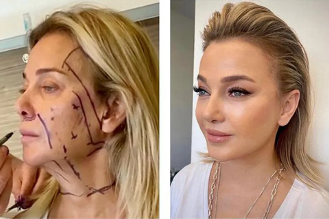 Before and after — Dr. Andrew Jacono