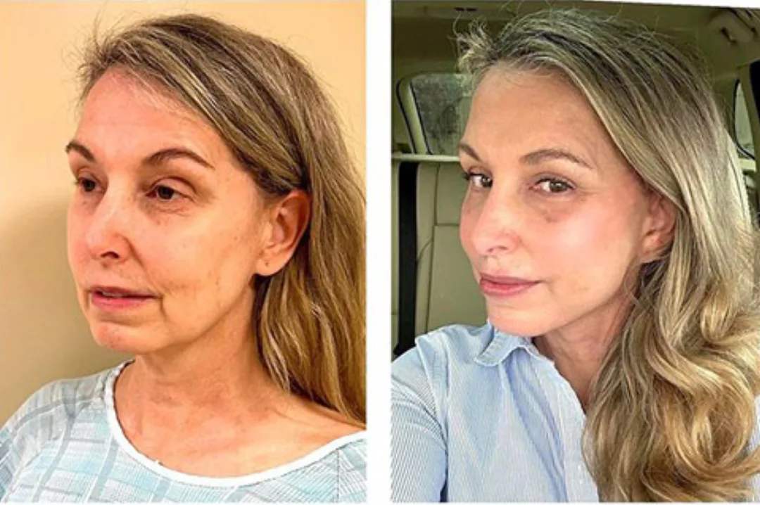 Before and after — Dr. Andrew Jacono