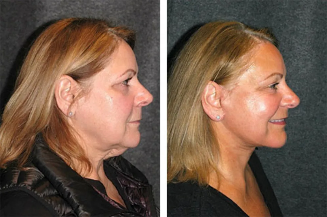 Before and after — Dr. Andrew Jacono