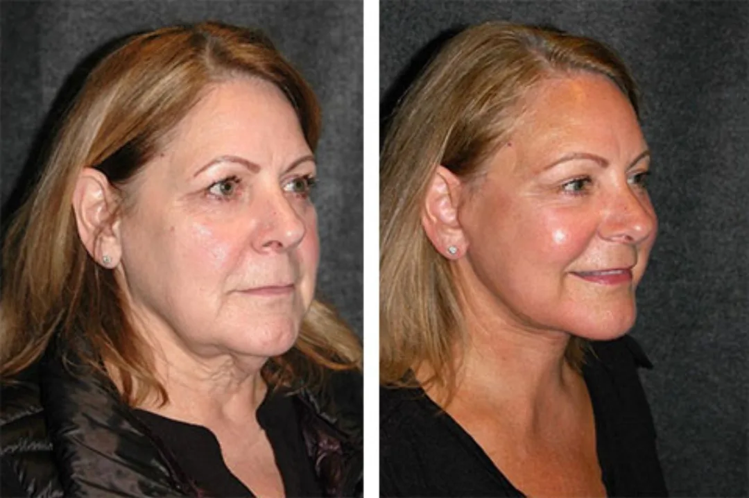 Before and after — Dr. Andrew Jacono