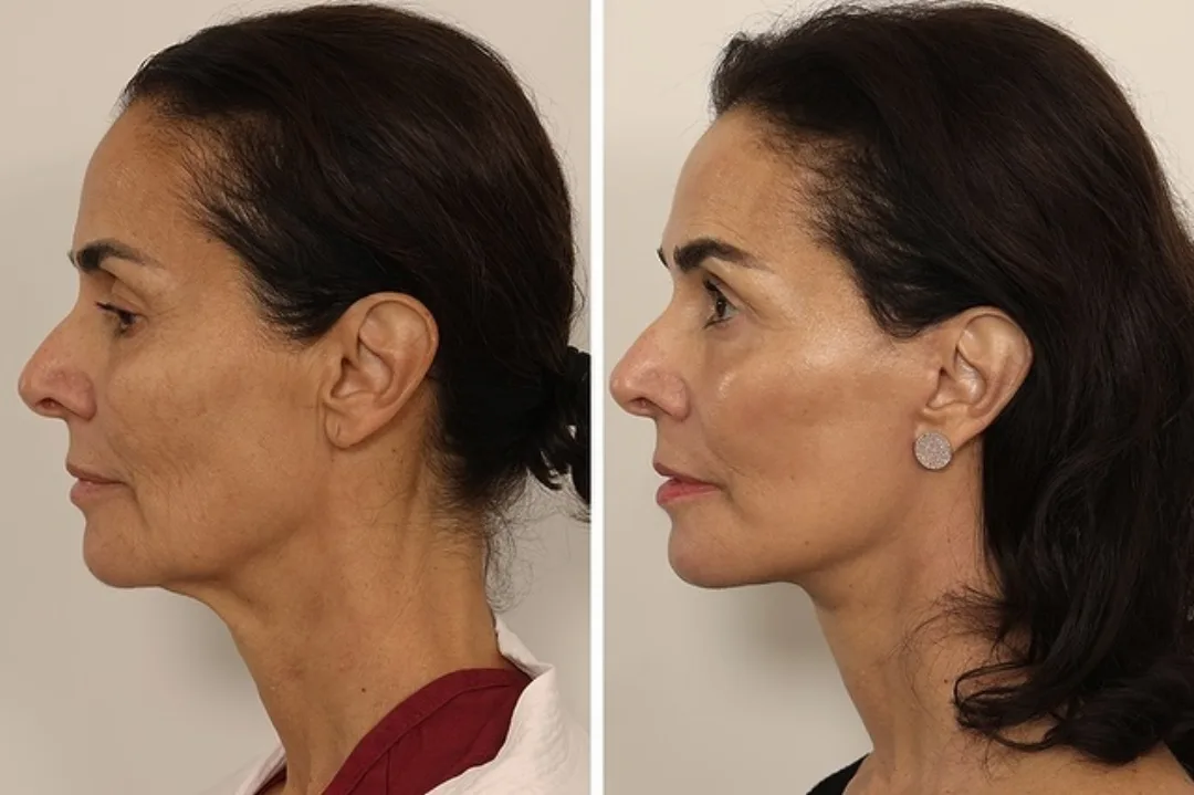 Before and after deep plane facelift — 65-year-old woman, left profile view, 5mo post-op by Dr. Andrew Timberlake