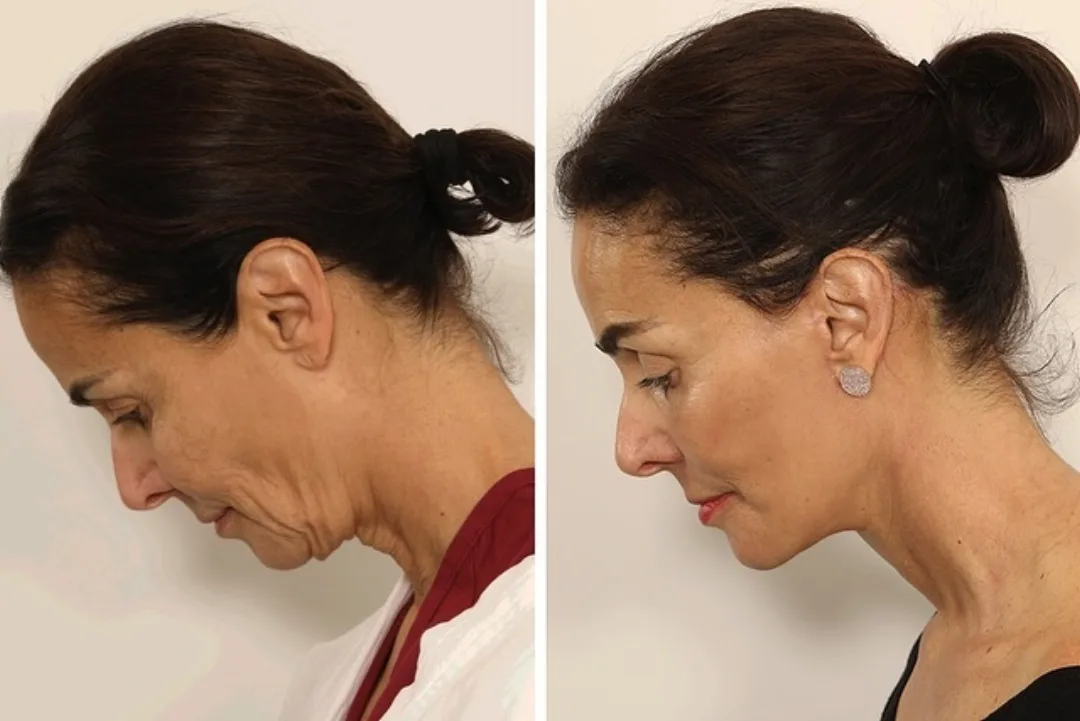 Before and after deep plane facelift — 65-year-old woman, left profile view, 5mo post-op by Dr. Andrew Timberlake