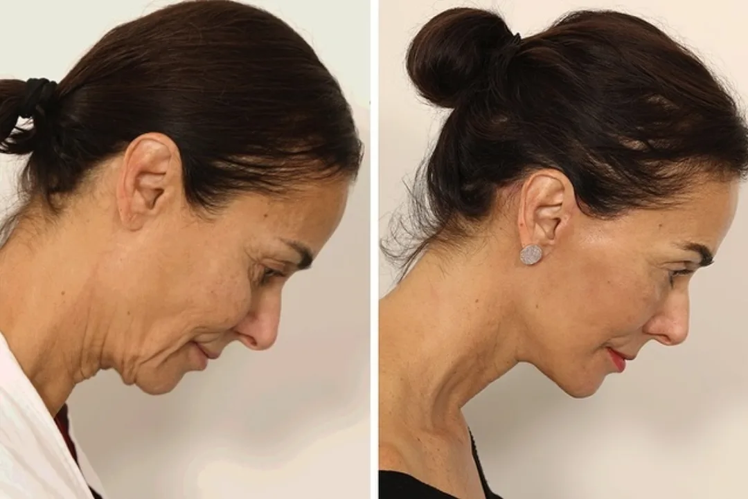 Before and after deep plane facelift — 65-year-old woman, right profile view, 5mo post-op by Dr. Andrew Timberlake