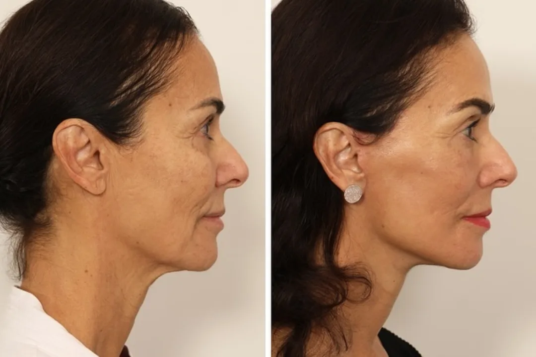 Before and after deep plane facelift — 65-year-old woman, right profile view, 5mo post-op by Dr. Andrew Timberlake