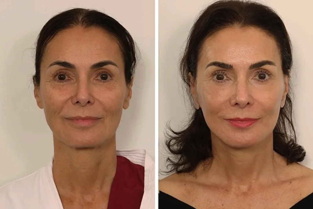 Before and after deep plane facelift — 65-year-old woman, frontal view, 5mo post-op by Dr. Andrew Timberlake