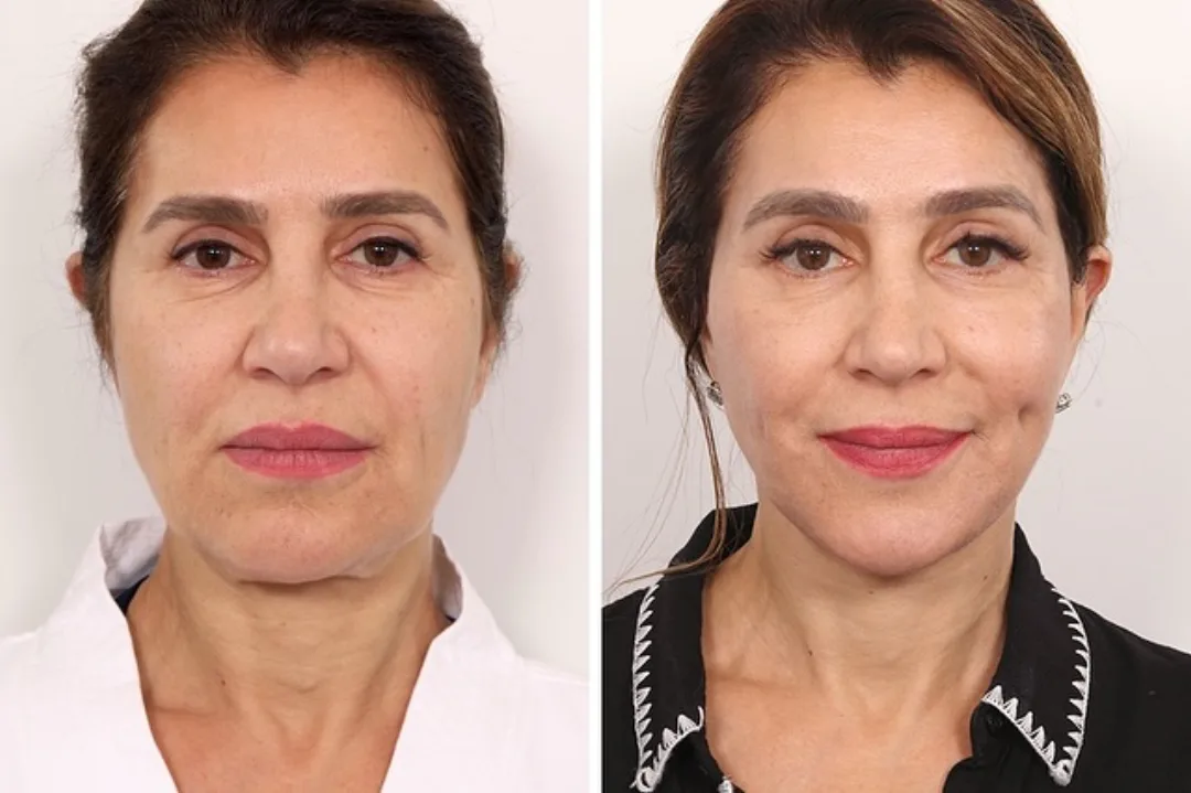 Before and after deep plane facelift — 60-year-old woman, frontal view, 4mo post-op by Dr. Andrew Timberlake