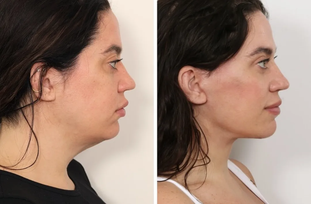 Before and after deep plane facelift — 42-year-old woman, right profile view, 1mo post-op by Dr. Andrew Timberlake
