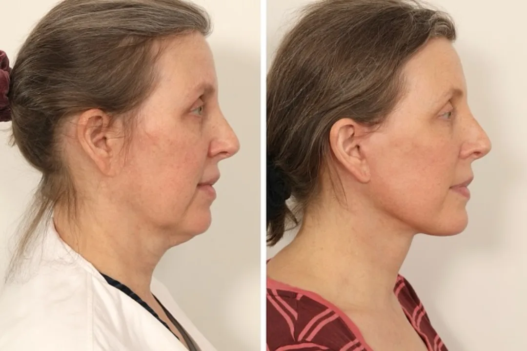 Before and after deep plane facelift — 52-year-old woman, right profile view, 5mo post-op by Dr. Andrew Timberlake