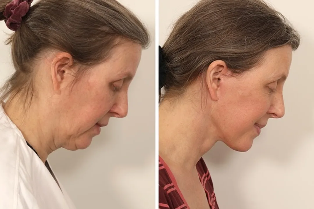 Before and after deep plane facelift — 52-year-old woman, right profile view, 5mo post-op by Dr. Andrew Timberlake