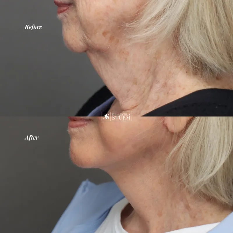 Before and after deep plane facelift, frontal view by Dr. Angela Sturm