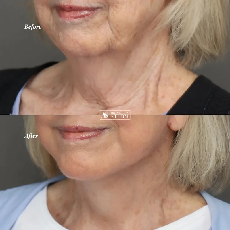 Before and after deep plane facelift, frontal view by Dr. Angela Sturm