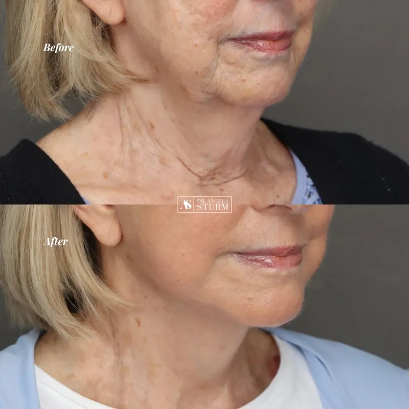 Before and after deep plane facelift, frontal view by Dr. Angela Sturm
