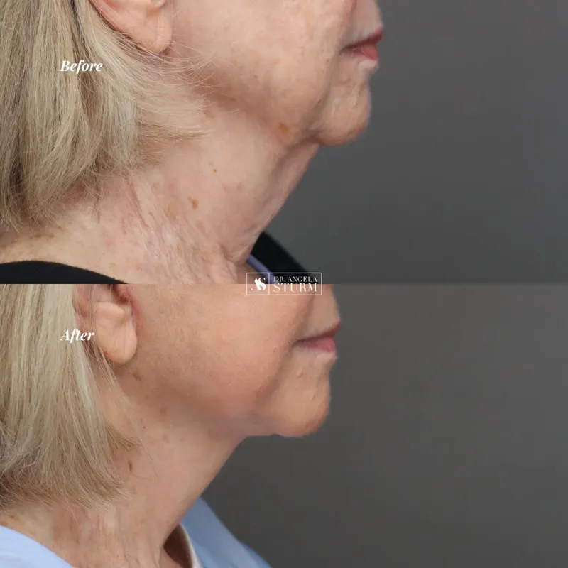 Before and after deep plane facelift, frontal view by Dr. Angela Sturm