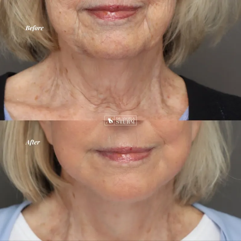 Before and after deep plane facelift, frontal view by Dr. Angela Sturm
