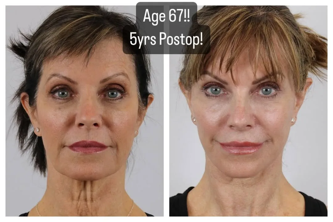 Before and after — Dr. Anthony Admire