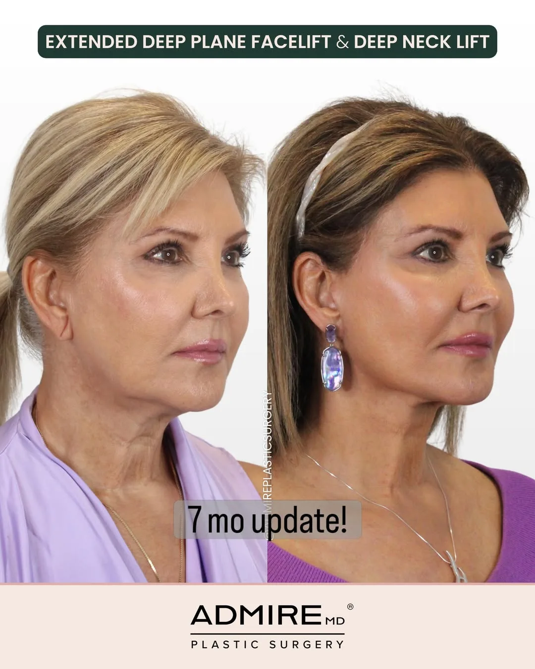Before and after — Dr. Anthony Admire