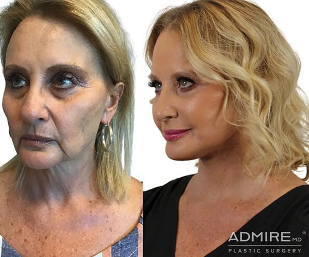 Before and after — Dr. Anthony Admire