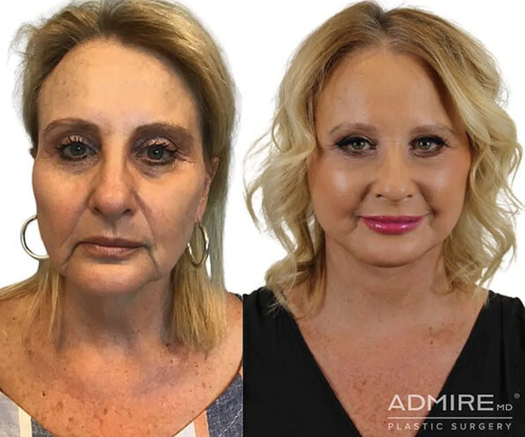 Before and after — Dr. Anthony Admire