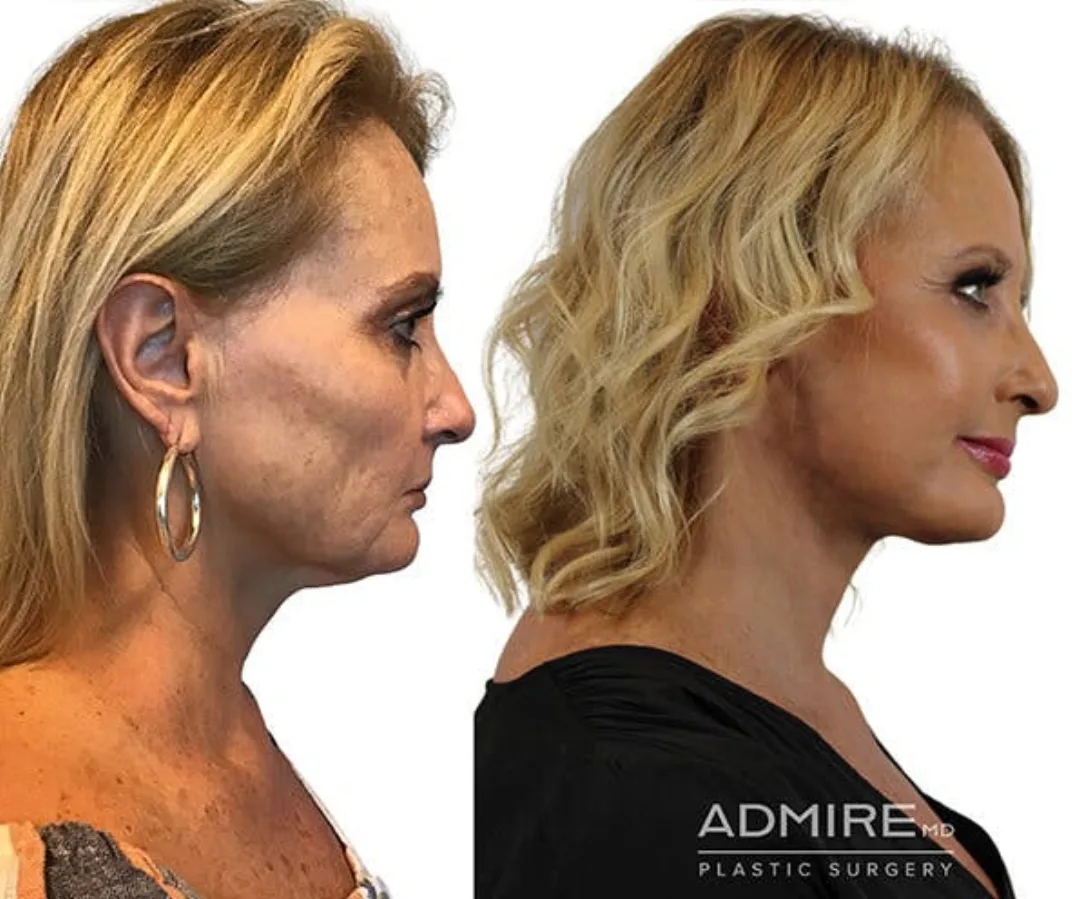 Before and after — Dr. Anthony Admire