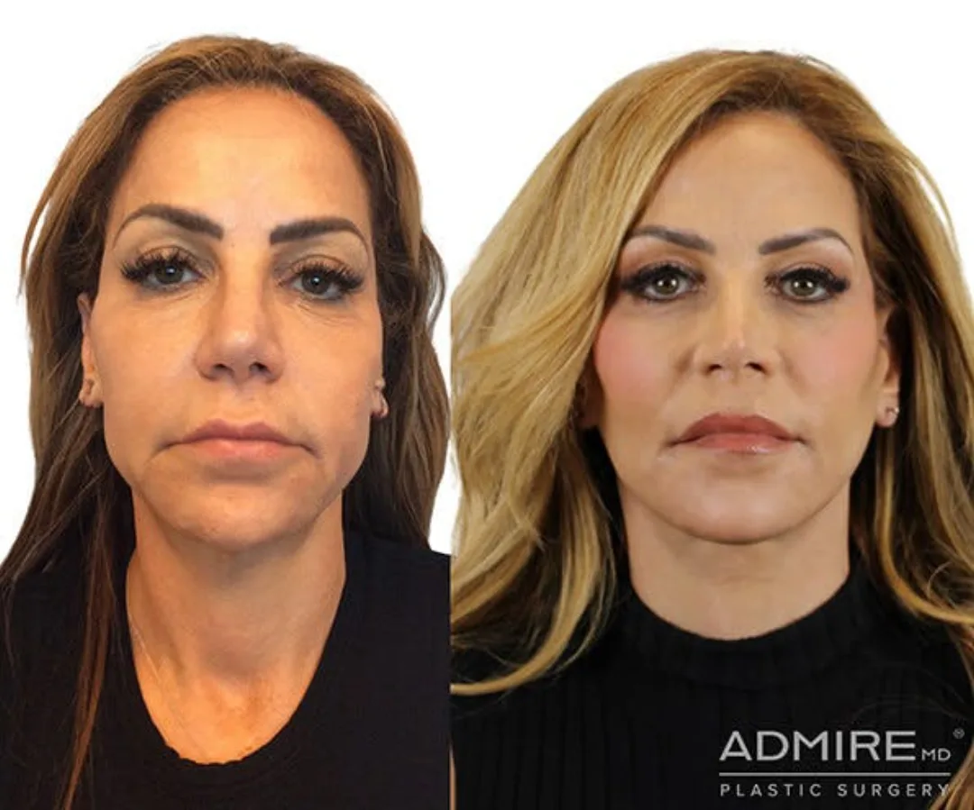 Before and after — Dr. Anthony Admire