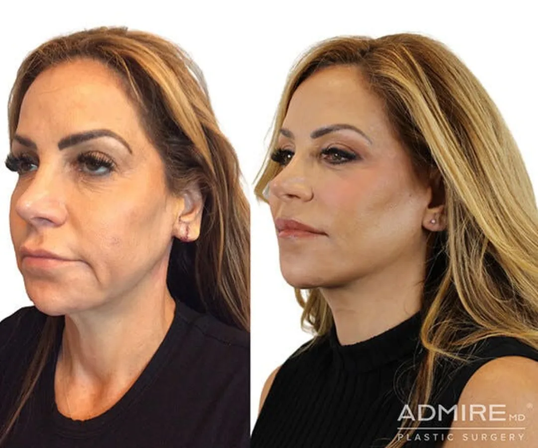 Before and after — Dr. Anthony Admire