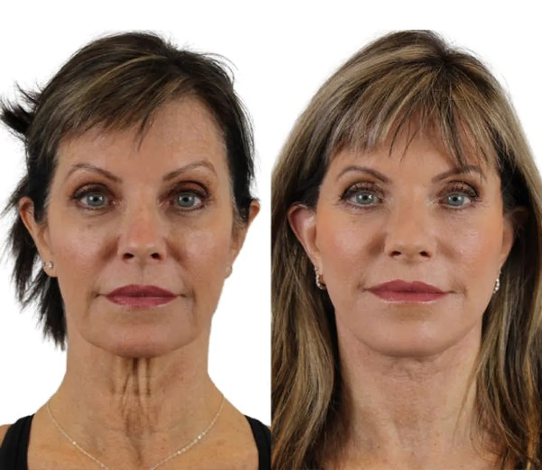 Before and after — Dr. Anthony Admire
