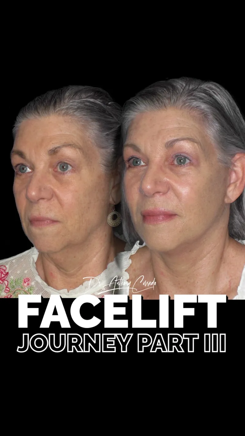Before and after: Dr. Anthony Corrado