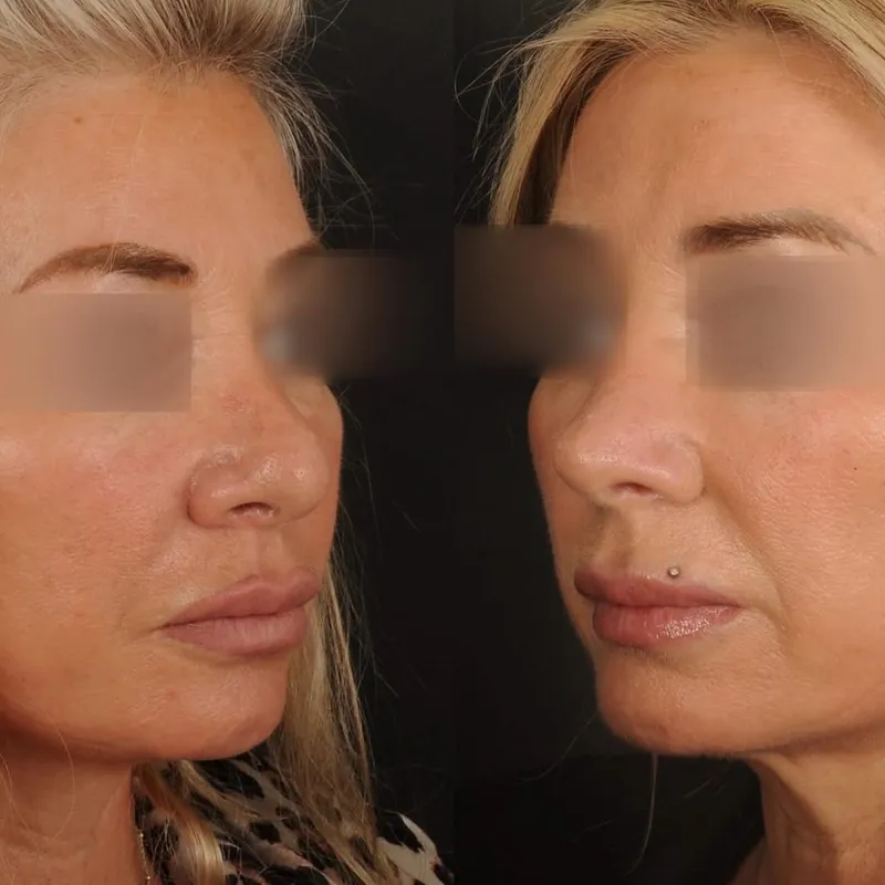 Before and after — Dr. Antoine Lavie