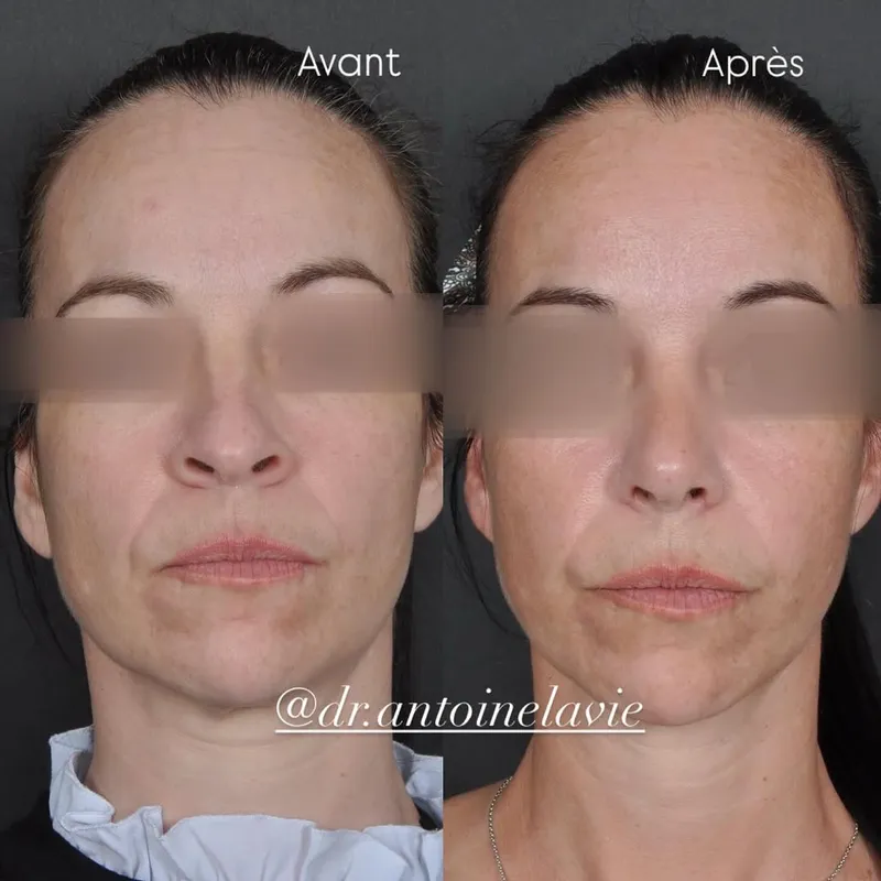 Before and after — Dr. Antoine Lavie