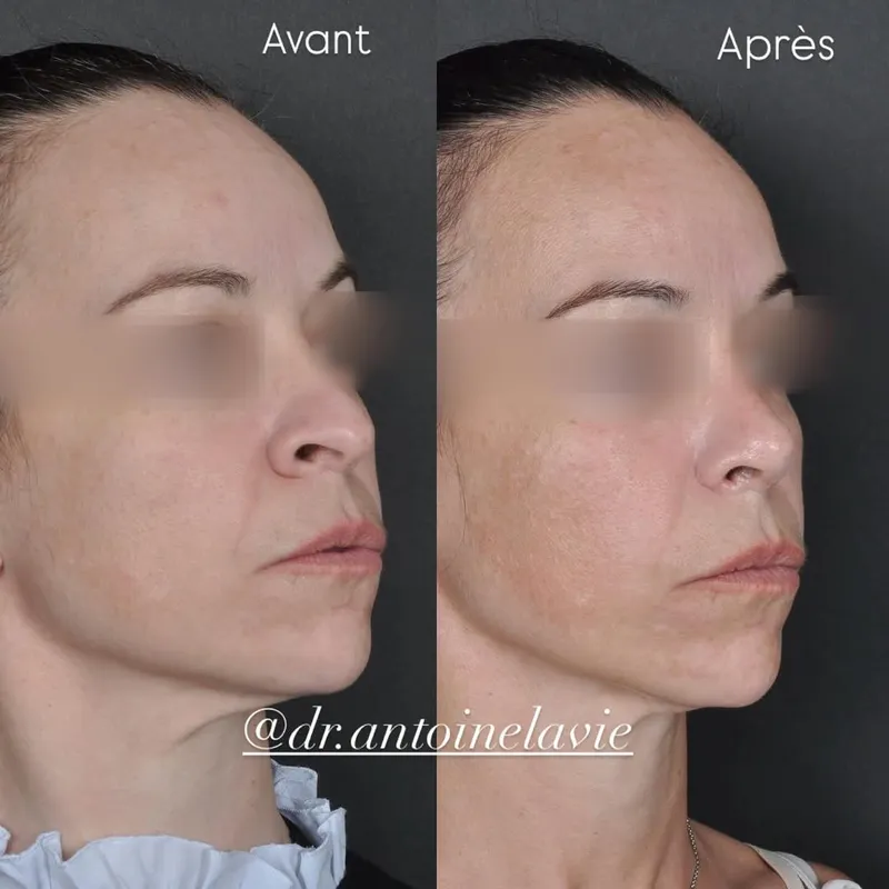Before and after — Dr. Antoine Lavie