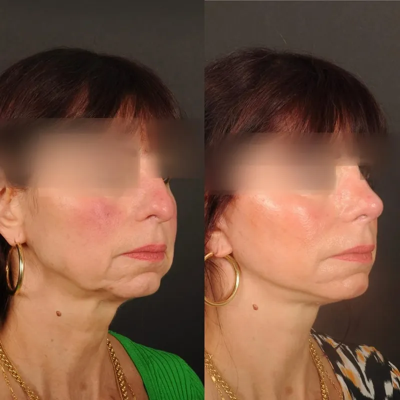 Before and after — Dr. Antoine Lavie