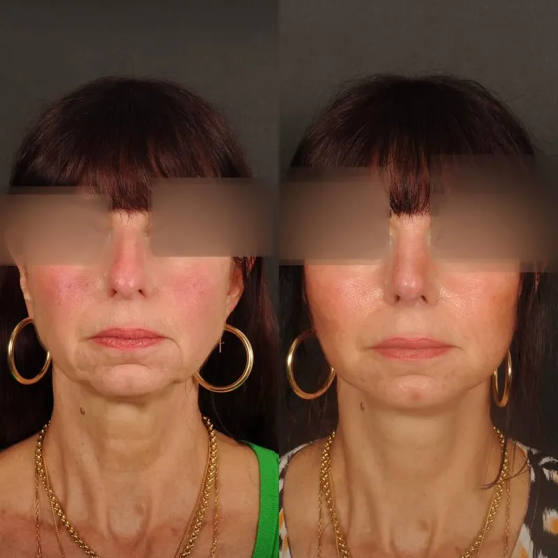 Before and after — Dr. Antoine Lavie