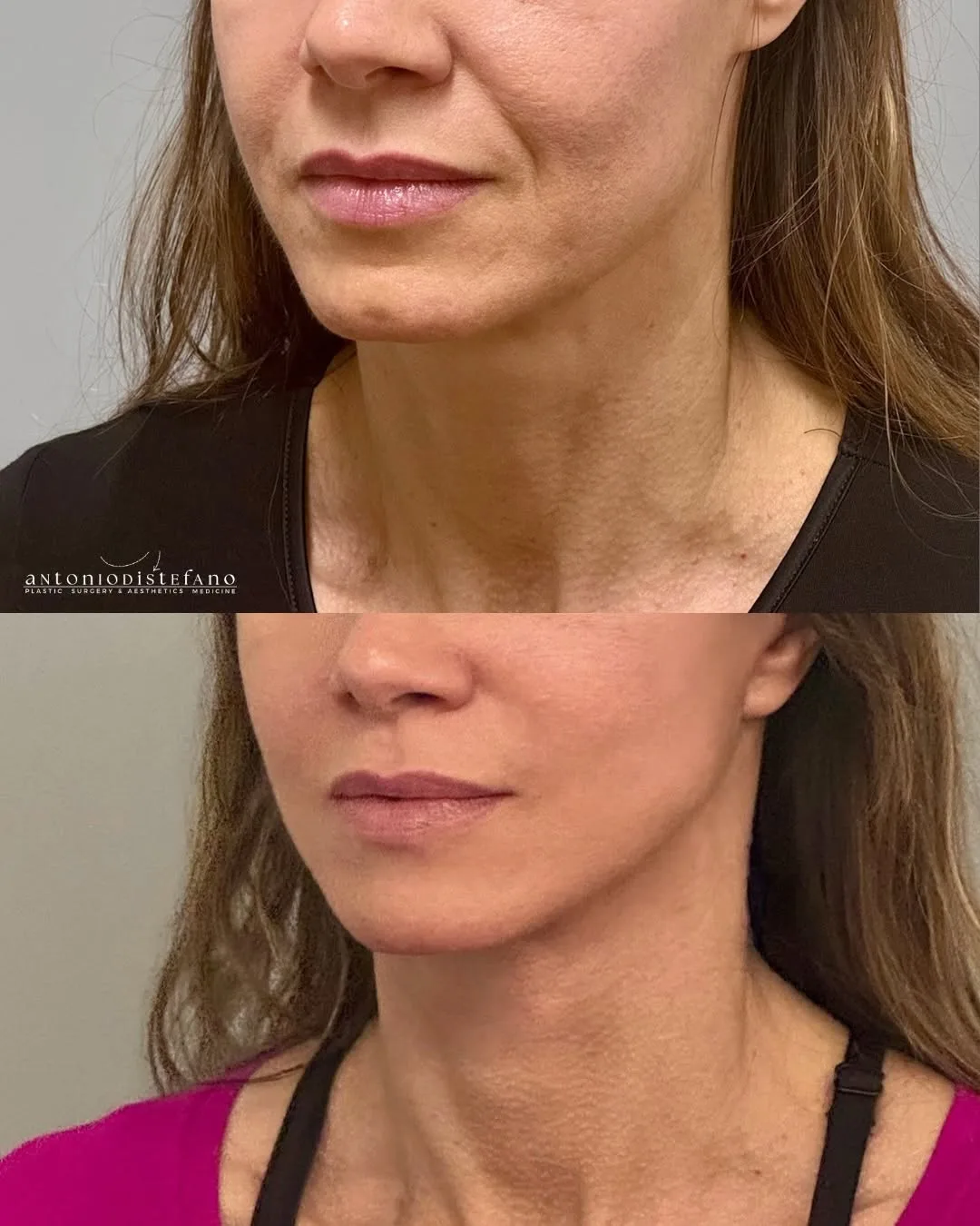 Before and after — Dr. Antonio Distefano