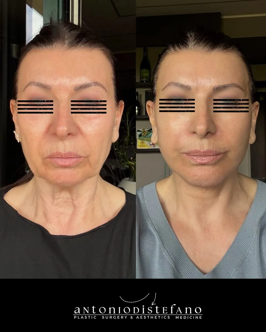 Before and after — Dr. Antonio Distefano