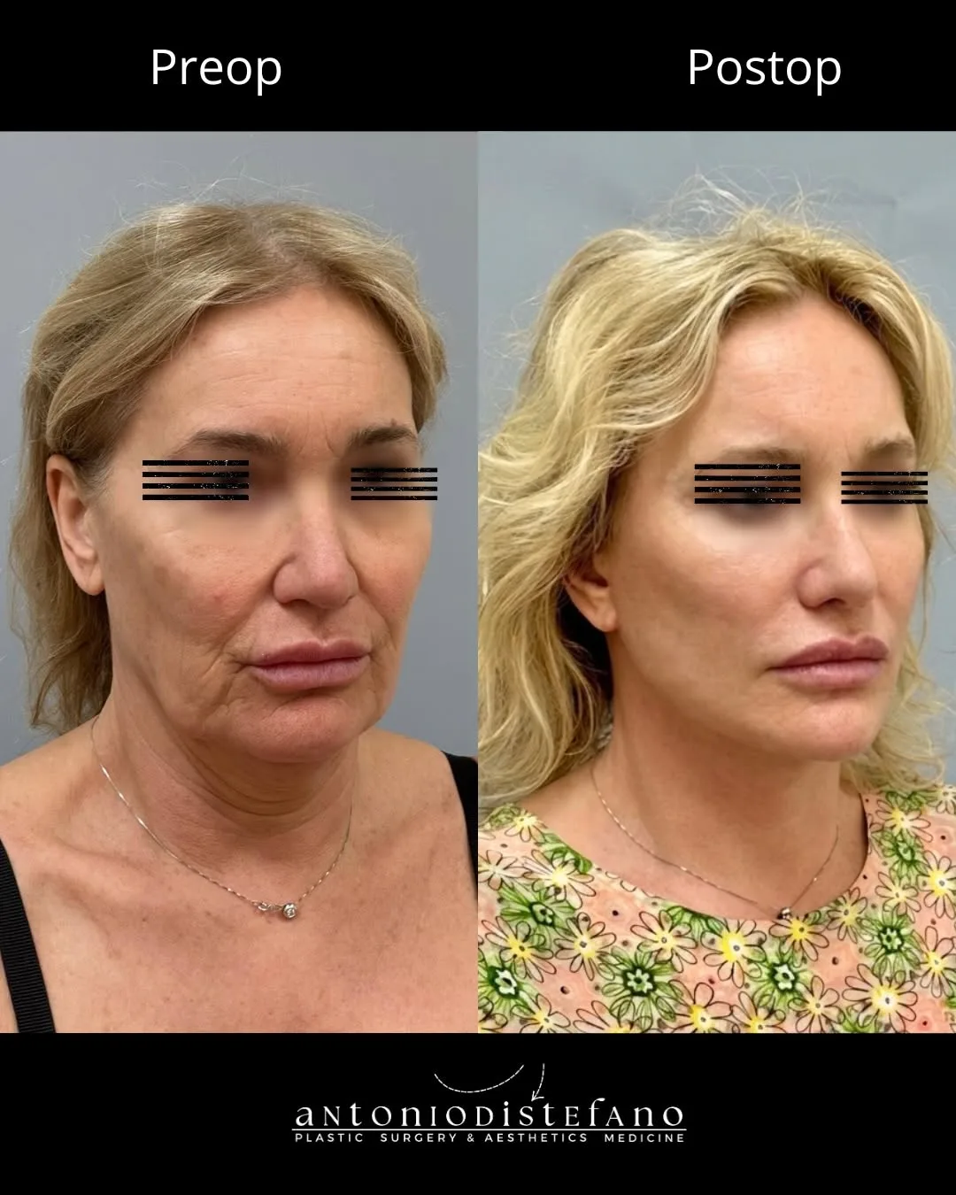 Before and after — Dr. Antonio Distefano